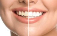 Best 11 Teeth Whitener App: Enhance your photo